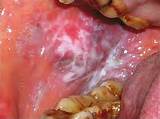 Lichen Planus Causes Cancer Images