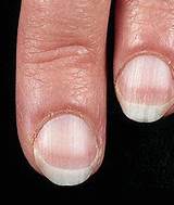 Nail Health Problems Images