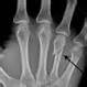 Images of Fracture Symptoms And Signs