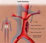 Photos of Acute Type B Aortic Dissection