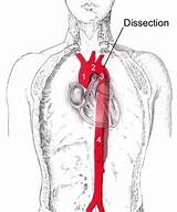 Pictures of Descending Aortic Dissection