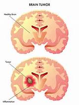 Images of Very Rare Brain Tumors