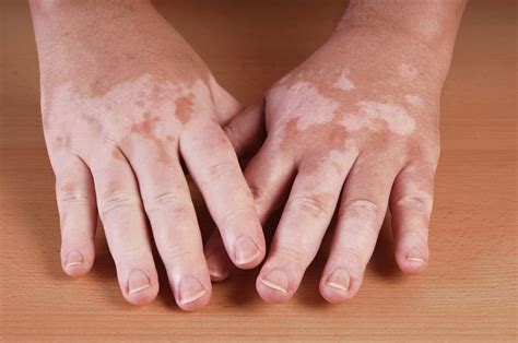facts  didnt   vitiligo vipoc