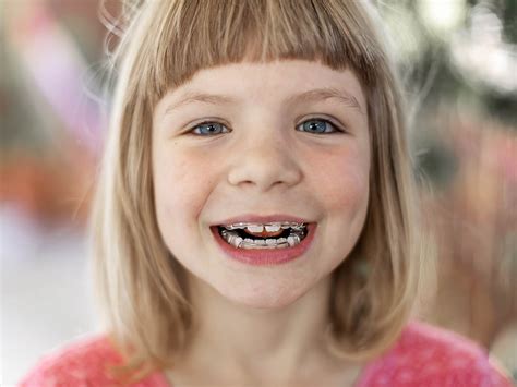 Benefits Of Early Treatment Parkside Orthodontics