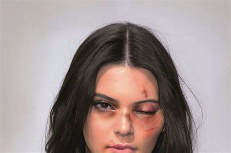 Kim Kardashian ‘bruised And Battered’ And Left With Black Eyes In