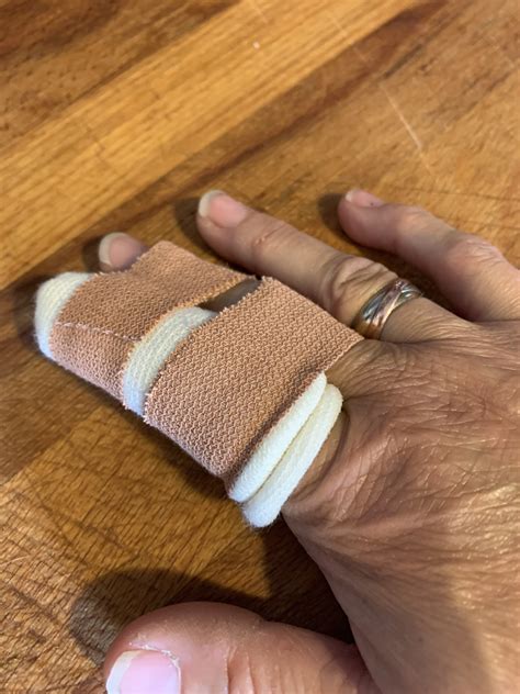 why you should not ignore a broken finger