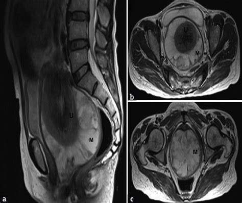 a sagittal t2 weighted magnetic resonance imaging shows t2