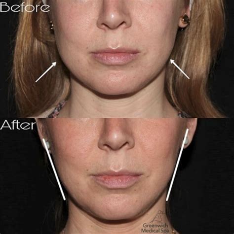 amazing    patient   botox   masseter