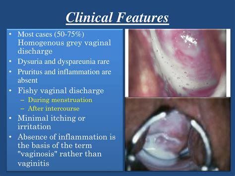 Ppt Candida Infection T Ricpmonas Vaginalis Bacterial