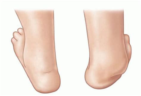 Anterior Tibialis Transfer For Residual Clubfoot Deformity