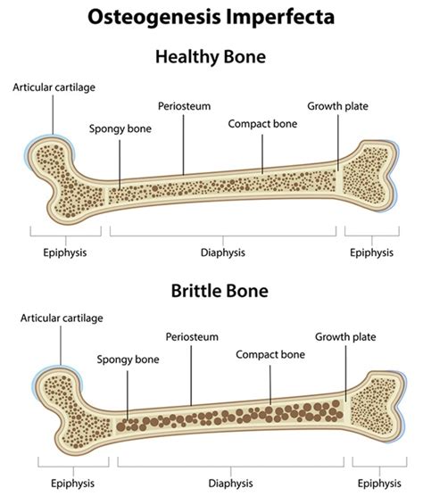 Types Of Osteogenesis Imperfecta Oi Brittle Bone Disease