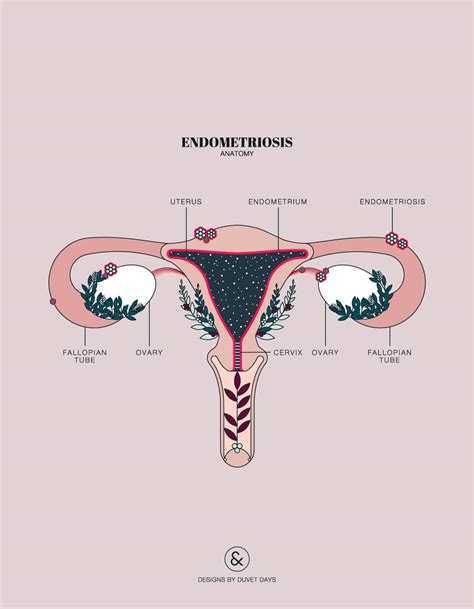 endometriosis anatomy designs  duvet days