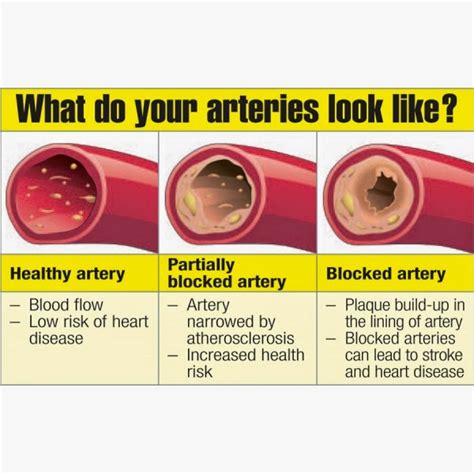 clean  arteries naturally foods  drinks  natural unclogging