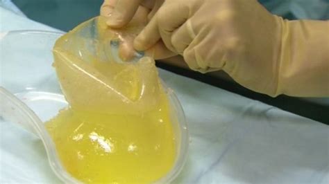 pip breast implants £1 2m removal cost not being reclaimed in wales