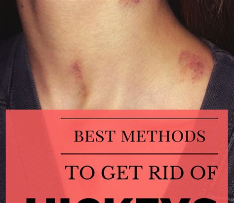 how to remove kiss mark on neck fast howto techno
