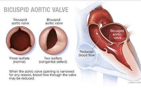 Mayo Clinic Qanda What Is A Bicuspid Aortic Valve Pine Journal