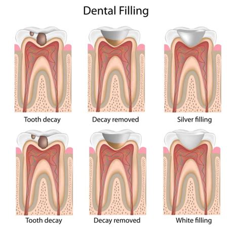 long  composite fillings  kimia family dentistry