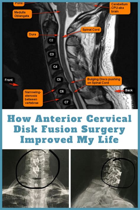 How Anterior Cervical Disk Fusion Surgery Improved My Life