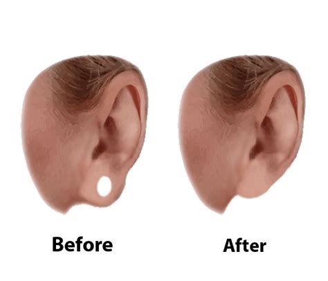 Ear And Earlobe Surgery Visage Facial Plastic Surgery