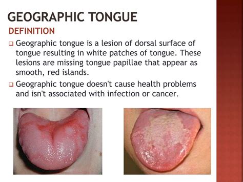ppt tongue disorders powerpoint presentation free