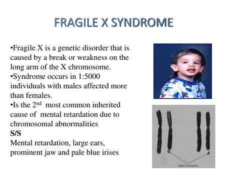 The Fragile X Syndromes Chromosome Abnormalities And Genetic My Xxx