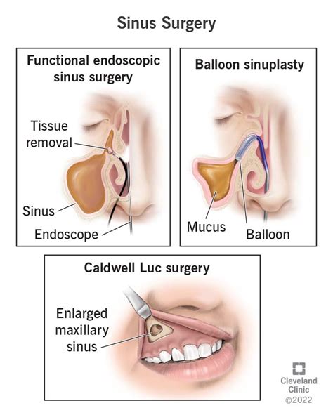 sinus surgery types procedure recovery