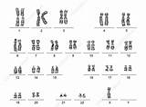 Turner Syndrome Karyotype Human Sciencephoto sketch template