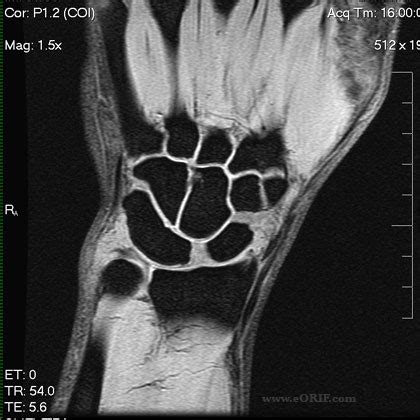 scapholunate ligament repair eorif