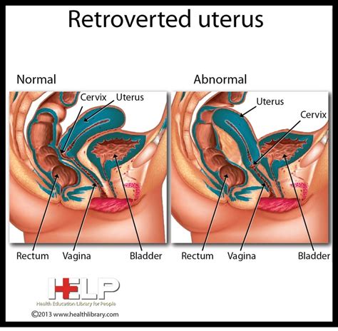 Retroverted Uterus Retroverted Uterus Abnormal Cervix