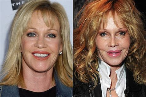 Hollywood Stars Before And After Plastic Surgery Viral