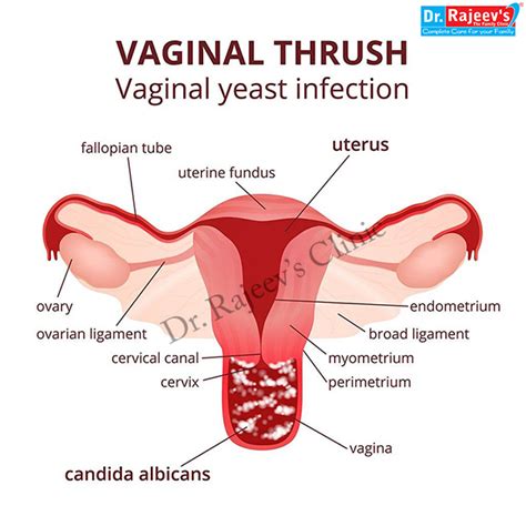 homeopathic treatment for vaginal thrush