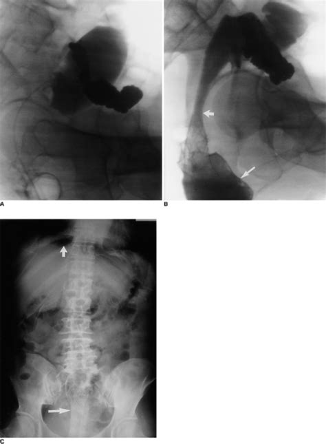 Figure 1 Delayed Colon Perforation After Palliative Treatment For