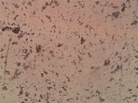 amorphous phosphate crystals  urine sediment  microscopy
