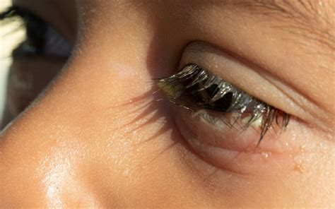 rid  eyelash mites fast  theralife