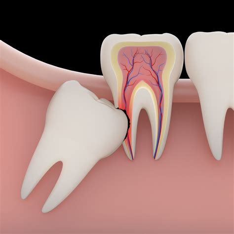 tooth extraction  bridge nj wisdom teeth neptune nj