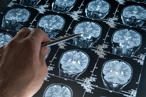 guz przysadki mozgowej przyczyny objawy leczenie poradnikzdrowiepl