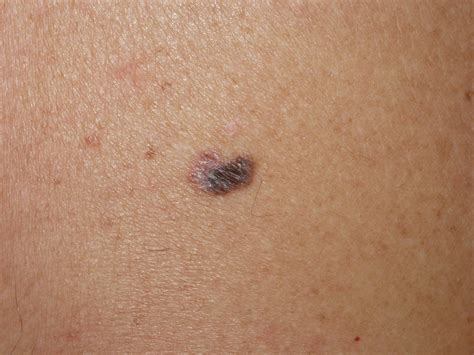 cancro della pelle melanoma  scoprirlo  quali sono  sintomi