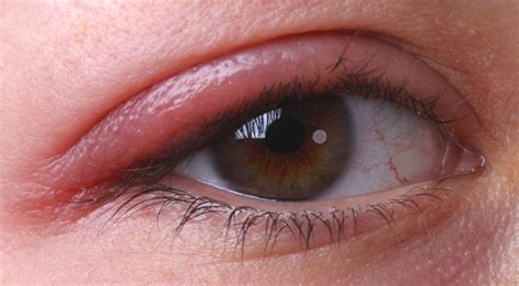 5 Home Remedies For Blepharitis