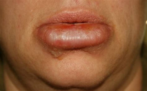 swollen lips  treatment pictures remedies  updated