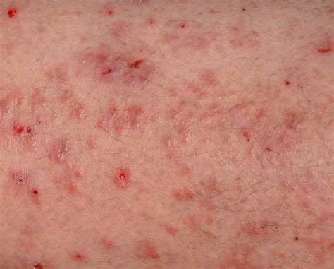 effective home remedies to to get rid of scabies naturally