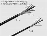 Radiofrequency Ablation Closure Vnus Rfa Catheters Fg 6fg Original Whiteley Veins Varicose Holdstock Judy Mark Used Treatment 12th Endovenous Operation sketch template