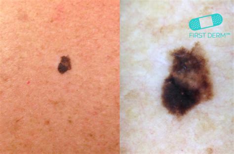 Can You Spot The Cancerous Mole Online Dermatology
