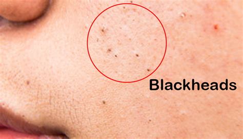 blackheads  symptoms prevention  treatment healthylopo