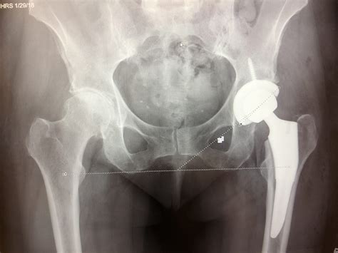 anterior hip replacement surgery  overview osms orthopedic  rheumatology services