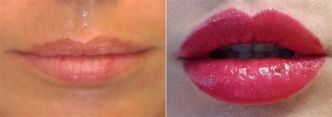lip augmentation best lip injections virginia washington dc maryland