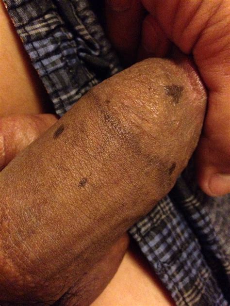 mole on penis shaft hidden dorm sex