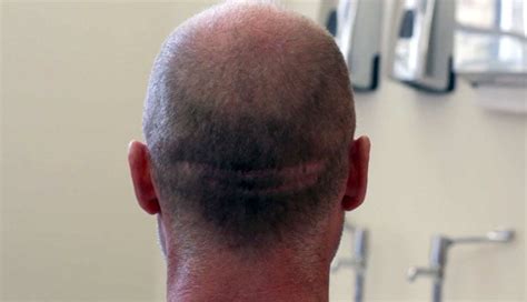hair transplant scar repair results  hair transplant scar repair uk