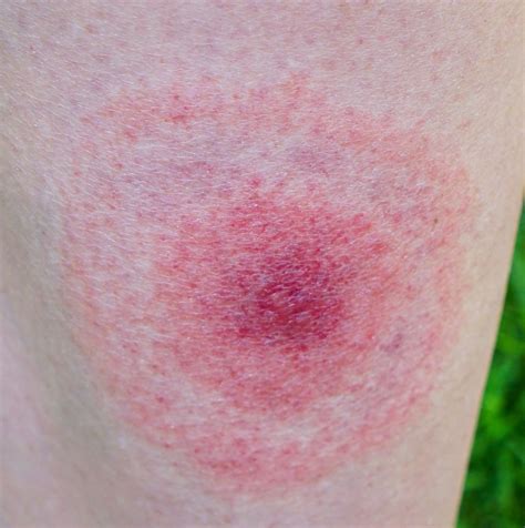 Is A Rash A Symptom Of Lyme Disease