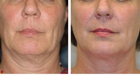 thermage   surgical face lifts   tighten loose skin