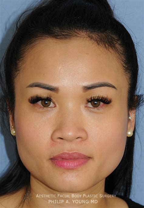 asian plastic surgery before and after photos seattle bellevue